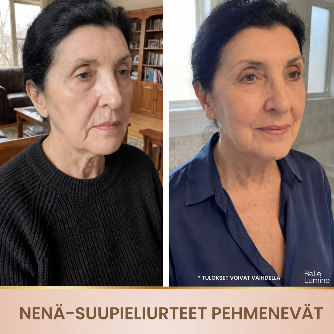 Ennen ja jälkeen – nenä-suupieliuurteet pehmenevät