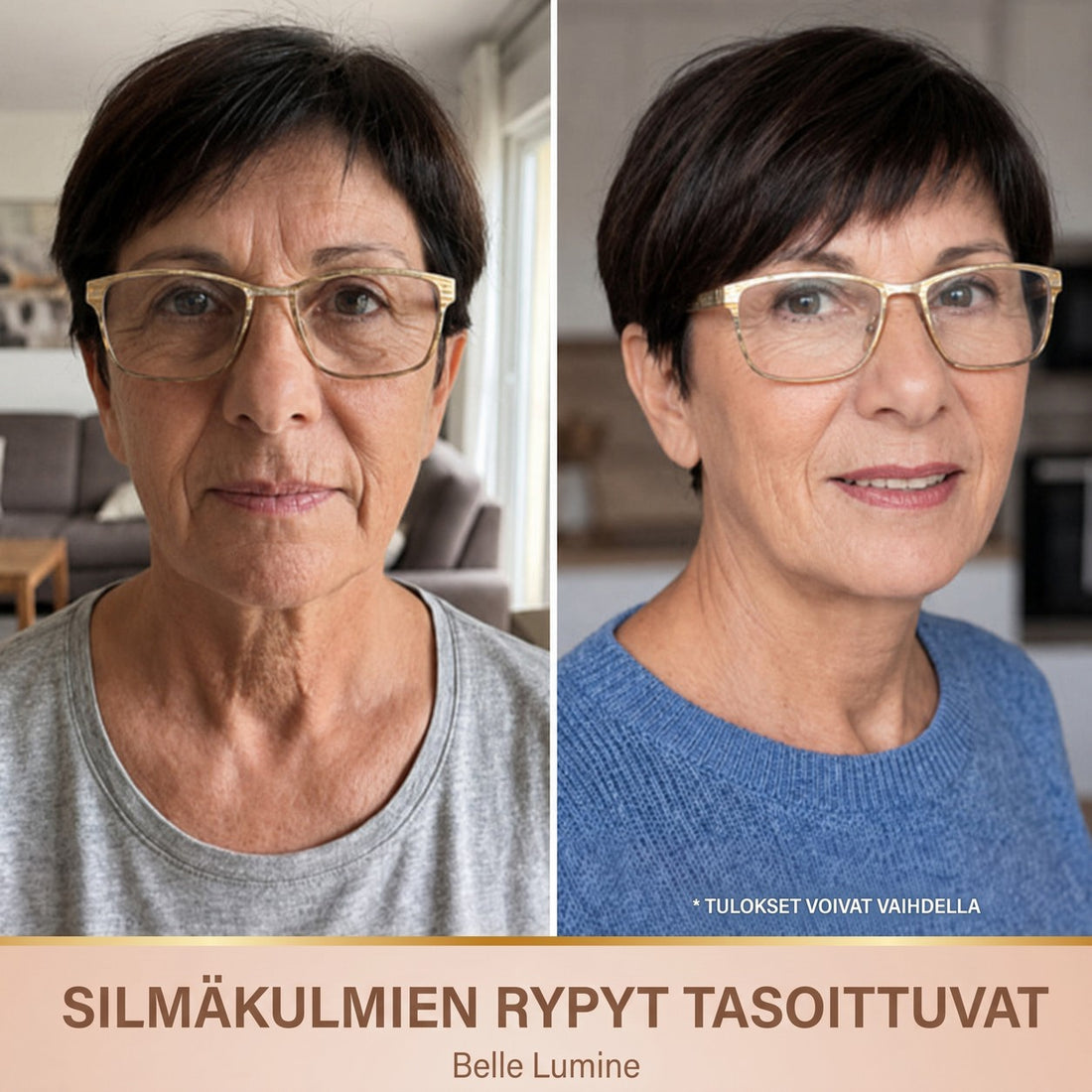 Ennen ja jälkeen – silmäkulmien rypyt tasoittuvat